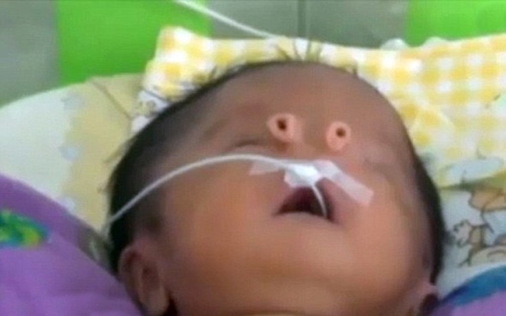 Μωρό χωρίς μύτη γεννήθηκε στο Περού