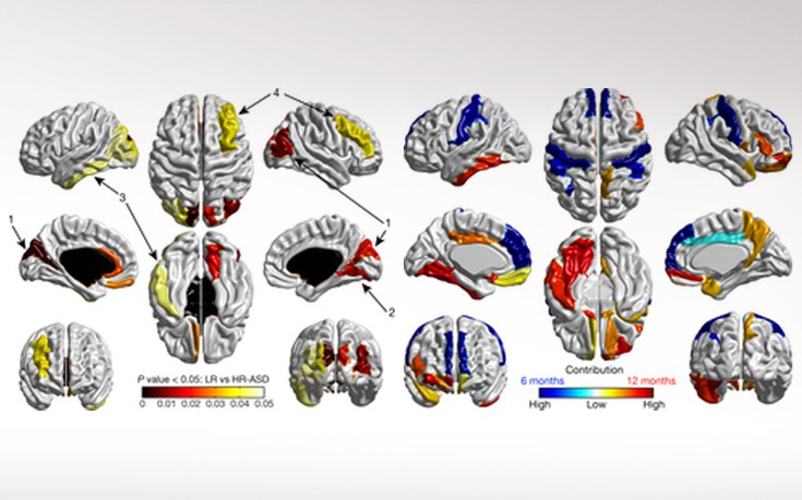 Αλγόριθμος διαβάζει τον εγκέφαλο των βρεφών και προβλέπει τον αυτισμό